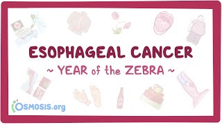 Esophageal Cancer Year of the Zebra [upl. by Swanhilda643]