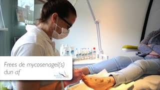 VLOG 2 TUTORIAL Oplossing voor MYCOSENAGELS [upl. by Atined]