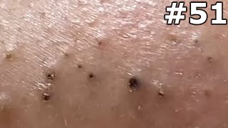 quot🔴 Satisfying Pimple Popping Extravaganza Watch the Most Satisfying Pops Everquot 51 [upl. by Leggett]