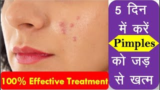 Natural remedy for pimples  Pimples removal on face at home  पिंपल्स हटाने के उपाय [upl. by Atined]