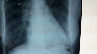 Bronchiectasis Chest Xray  What is bronchiectasis [upl. by Diva112]