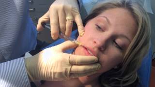 Juvederm Lip Augmentation in Richmond VA [upl. by Olecram]