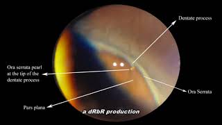 Ora Serrata pearl Scleral depression [upl. by Epp]