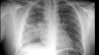 Miliary Tb on X ray [upl. by Ecila]