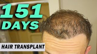 FUE Hair Transplant 151 Days post op Istanbul Turkey GROWTH STAGE [upl. by Leoni702]