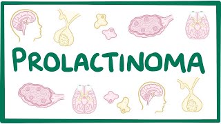 Prolactinoma  causes symptoms diagnosis treatment pathology [upl. by Cleave]