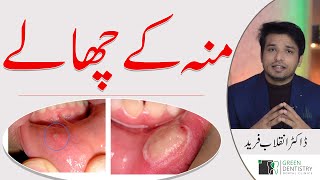 Mouth Ulcers  Oral Ulcers  Causes  Home Treatment  Prevention  Dr Inqalab F  Urdu  Hindi [upl. by Eelah]