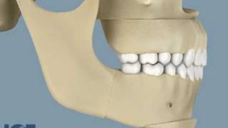 Orthognathic Surgery [upl. by Adnac]