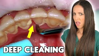 Deep Cleaning With HEAVY Tartar Build Up At The Dentist [upl. by Cormick]