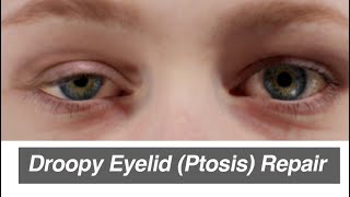 Droopy Eyelid Ptosis Repair [upl. by Yrem473]