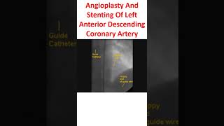 Angioplasty And Stenting Of Left Anterior Descending Coronary Artery [upl. by Shuping560]