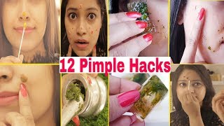 Pimple को रात भर में ठीक करने के 12 आसान तरीके12 Hacks to Remove Pimple OvernightBe Natural [upl. by Aleda]