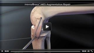 InternalBrace™ MCL Augmentation Repair [upl. by Peednam]