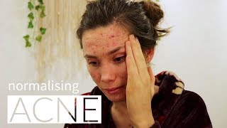 Normalising Acne  Documentary  Cerys Davies [upl. by Meesan]