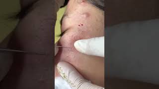 Best Pimple Popping 11 beautiful blackheads sacdepspa [upl. by Almund110]