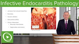 Infective Endocarditis IE Pathology – Infectious Diseases  Lecturio [upl. by Estrellita]