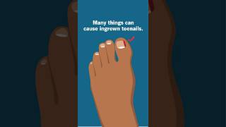 Causes of those painful ingrown toenails Ouch [upl. by Pillyhp]