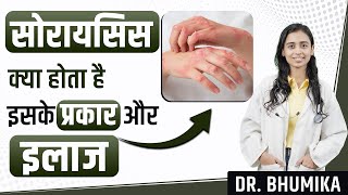 Psoriasis Symptoms Causes and Treatment  Psoriasis Treatment  Dr Bhumika [upl. by Tahmosh]