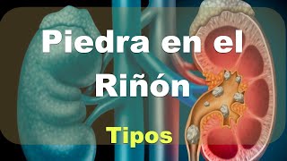 Piedra en el riñón Litiasis renal Tipos comparativa [upl. by Warton]