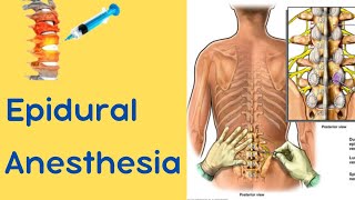 Epidural Anesthesia [upl. by Hutson]