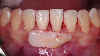 Root coverage on lower ant tooth [upl. by Eterg]