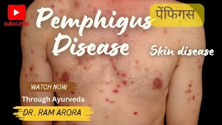 Pemphigus  पेम्फीगस  Skin disease  Treatment Through Ayurveda  Dr Ram Arora [upl. by Glorianna]