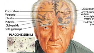 Qual è la differenza tra Alzheimer e demenza senile  Nuova Vita [upl. by Ecire]