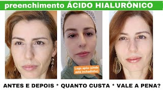 Fiz Preenchimento com ÁCIDO HIALURÔNICO  antes e depois  veja tudo aqui [upl. by Azilanna397]