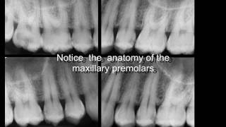 Three rooted maxillary premolars [upl. by Mosley381]