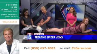 Treating Spider Veins [upl. by Alameda]