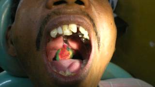 Dr Pankaj Kharade Pharyngeal obturator impression [upl. by Kilbride762]