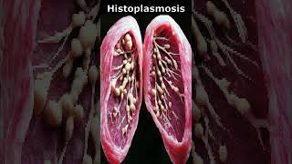 🦠Histoplasmosis🌡️ [upl. by Suzie]