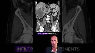 Renal cell carcinoma CT interpretation radiology medicalstudent radiologist radiographer [upl. by Clarence553]