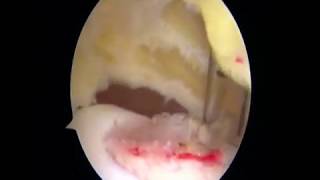 Arthroscopic Osteochondral Autograft Transfer for Juvenile Osteochondritis Dissecans [upl. by Alol]