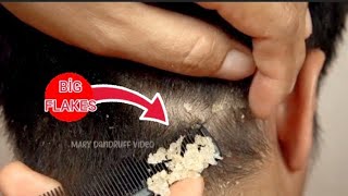 İnanılmaz Rahatlatan Kepek Temizleme Videosu  Dandruff Egzama Saç Bakım Hair Removal kepek ASMR [upl. by Araec]