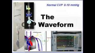 CVP and Arterial Line Waveform Interpretation [upl. by Avery]