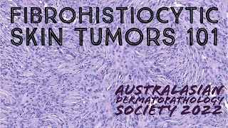 Fibrohistiocytic Skin Tumors 101 Australasian Dermatopathology Society 2022 meeting pathology [upl. by Jenine]