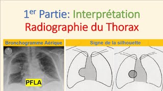 Interprétation Téléthorax N°01 Radiographie du Thorax Syndrome Alvéolaire Pneumologie imagerie PFLA [upl. by Hartley]