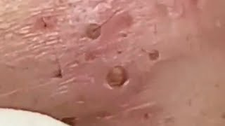 Blackheads amp Whiteheads Satisfying Removal 0105 [upl. by Arolf]