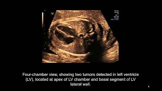 Fetal cardiac tumor echocardiography clinical outcome and genetic analysis in 53 cases [upl. by Yrohcaz]