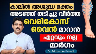 കാലിൽ അശുദ്ധ രക്തം അടഞ്ഞ് തടിച്ചു വീർത്ത വെരികോസ് വൈൻ മാറാൻ ഏറ്റവും നല്ല മാർഗം \ varicose veins [upl. by Aitnis]