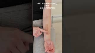 Narbenbehandlung mit Silikonpflaster [upl. by Nonnag750]