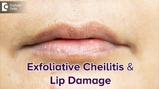 Exfoliative Cheilitis amp its effect on Lips  DRY LIPSBest TreatmentDrRasya Dixit Doctors Circle [upl. by Edna]