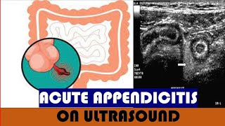 Acute appendicitis on Ultrasound [upl. by Mcmillan]