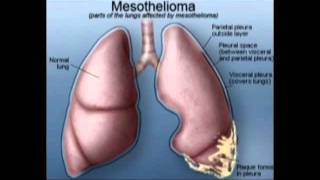 What Is Mesothelioma [upl. by Sirromaj276]