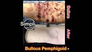 Bullous Pemphigoid Before and After [upl. by Shannan]