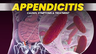 Understanding Appendicitis Causes Symptoms and Treatment  3D Animation [upl. by Lizned]