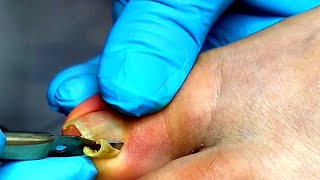 huge ingrown toenail [upl. by Suilienroc]