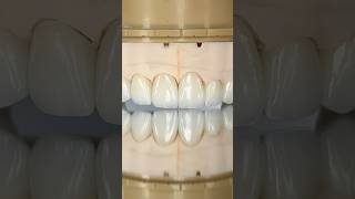 Maxillary Zen Enamel Zirconia Crowns ​⁠EnvisiontecMain envisiontec lsk121shorts dentist [upl. by Avid]