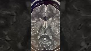 Como diferenciar infarto lacunar de espaço perivascular nos núcleos da base na ressonância de crânio [upl. by Flss824]